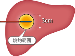 ���W�I�g�ĎܗÖ@